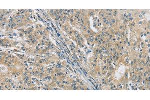 Immunohistochemistry of paraffin-embedded Human gasrtic cancer tissue using PKD1 Polyclonal Antibody at dilution 1:40 (PKD1 anticorps)