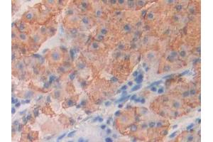 DAB staining on IHC-P; Samples: Human Stomach cancer Tissue (ICOS anticorps  (AA 31-190))