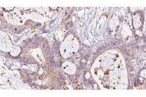 ABIN6267476 at 1/100 staining Human liver cancer tissue by IHC-P.