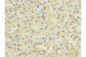 Immunohistochemistry of paraffin-embedded human gastric cancer using ABIN7157234 at dilution of 1:100