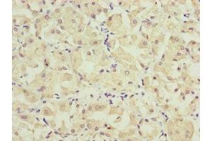 Immunohistochemistry of paraffin-embedded human gastric cancer using ABIN7157234 at dilution of 1:100 (KANSL3 anticorps  (AA 1-200))
