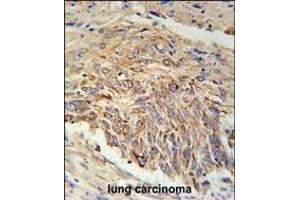 EBPL Antibody (C-term) (ABIN651922 and ABIN2840457) immunohistochemistry analysis in formalin fixed and paraffin embedded human lung carcinoma followed by peroxidase conjugation of the secondary antibody and DAB staining. (EBPL anticorps  (C-Term))