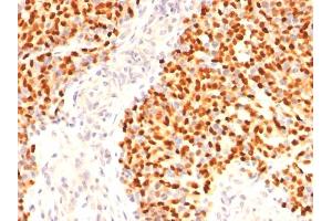 Formalin-fixed, paraffin-embedded human Rhabdomyosarcoma stained with Myogenin Mouse Monoclonal Antibody (F5D)