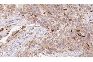 ABIN6278151 at 1/100 staining Human Melanoma tissue by IHC-P. (LGALS1/Galectin 1 anticorps)