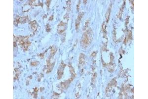 Formalin-fixed, paraffin-embedded human ovarian carcinoma stained. (TDRKH anticorps)