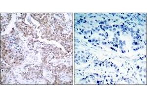 Immunohistochemistry analysis of paraffin-embedded human breast carcinoma, using p53 (Phospho-Ser15) Antibody. (p53 anticorps  (pSer15))