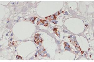 Immunohistochemistry of paraffin-embedded Human mammary cancer using ACSL3 Polyclonal Antibody at dilution of 1:100 (40x lens). (Acsl3 anticorps)