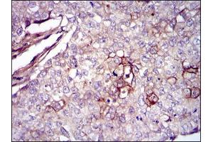 Immunohistochemical analysis of paraffin-embedded lung cancer tissues using FN1 mouse mAb with DAB staining.
