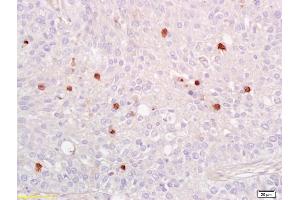 Formalin-fixed and paraffin embedded human lung carcinoma labeled with Anti-phospho-NFKB p65(Ser536) Polyclonal Antibody, Unconjugated (ABIN730528) at 1:200 followed by conjugation to the secondary antibody and DAB staining. (NF-kB p65 anticorps  (pSer536))