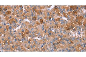 Immunohistochemistry of paraffin-embedded Human liver cancer tissue using GPC6 Polyclonal Antibody at dilution 1:40 (Glypican 6 anticorps)
