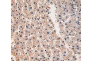 IHC-P analysis of Human Liver Cancer Tissue, with DAB staining. (CHI3L1 anticorps  (AA 112-377))