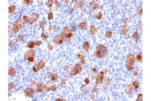 Formalin-fixed, paraffin-embedded human Hodgkin's Lymphoma stained with CD30 Mouse Recombinant Monoclonal Antibody (rKi-1/779).
