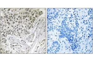 Immunohistochemistry analysis of paraffin-embedded human lung carcinoma tissue, using EFTUD2 Antibody. (EFTUD2 anticorps  (AA 321-370))