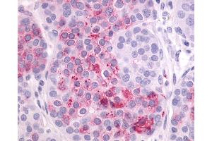 Anti-LPAR4 / GPR23 antibody IHC of human Ovary, Carcinoma.