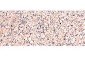 Immunohistochemistry of paraffin-embedded Human liver cancer tissue using RIOK1 Polyclonal Antibody at dilution of 1:80(x200) (RIOK1 anticorps)