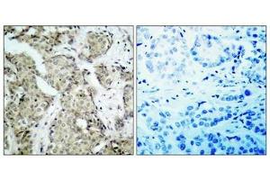 Immunohistochemical analysis of paraffin- embedded human breast carcinoma tissue using MKK6(Phospho-Ser207) Antibody(left) or the same antibody preincubated with blocking peptide(right).