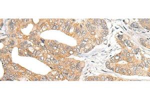 Immunohistochemistry of paraffin-embedded Human gastric cancer tissue using SNX6 Polyclonal Antibody at dilution of 1:40(x200) (SNX6 anticorps)