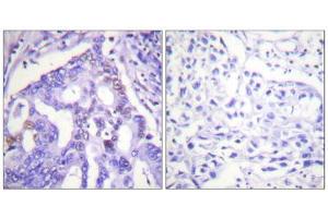 Immunohistochemistry analysis of paraffin-embedded human lung carcinoma tissue using PIAS4 antibody. (PIAS4 anticorps  (C-Term))