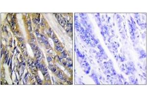 Immunohistochemistry analysis of paraffin-embedded human colon carcinoma tissue, using DGKH Antibody. (DGKH anticorps  (AA 771-820))