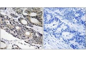 Immunohistochemistry analysis of paraffin-embedded human colon carcinoma tissue, using BCL10 Antibody.