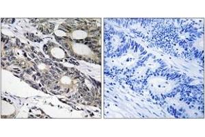 Immunohistochemistry analysis of paraffin-embedded human colon carcinoma tissue, using BCL10 Antibody. (BCL10 anticorps  (AA 111-160))