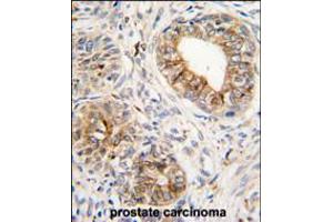 Formalin-fixed and paraffin-embedded human prostata carcinoma tissue reacted with PTGS1 antibody , which was peroxidase-conjugated to the secondary antibody, followed by DAB staining. (PTGS1 anticorps  (C-Term))