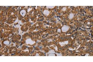 Immunohistochemistry of paraffin-embedded Human thyroid cancer tissue using PARP8 Polyclonal Antibody at dilution 1:40 (PARP8 anticorps)