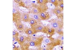 Immunohistochemical analysis of SHMT2 staining in human liver cancer formalin fixed paraffin embedded tissue section. (SHMT2 anticorps)