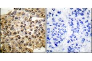 Immunohistochemistry analysis of paraffin-embedded human breast carcinoma tissue, using p44/42 MAPK Antibody. (ERK1/2 anticorps  (AA 330-379))