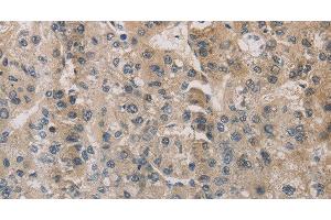 Immunohistochemistry of paraffin-embedded Human liver cancer using ESRRG Polyclonal Antibody at dilution of 1:30 (ESRRG anticorps)