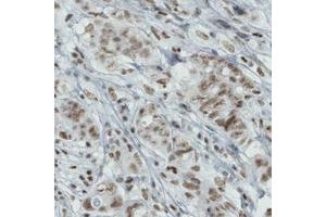 Immunohistochemical staining (Formalin-fixed paraffin-embedded sections) of human breast cancer with BRD4 monoclonal antibody, clone CL1115  shows moderate nuclear immunoreactivity in tumor cells.