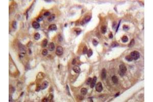 Immunohistochemistry analyzes of IKKγ antibody in paraffin-embedded human breast carcinoma tissue. (IKBKG anticorps)