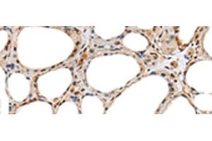 Immunohistochemistry of paraffin-embedded Human thyroid cancer tissue using RAB11A Polyclonal Antibody at dilution of 1:35(x200) (RAB11A anticorps)