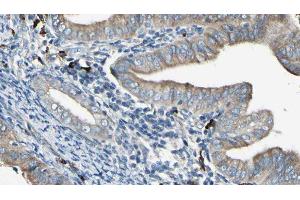 ABIN6277956 at 1/100 staining Human cervical cancer tissue by IHC-P. (SOAT1 anticorps  (Internal Region))