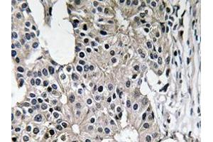 Immunohistochemistry analyzes of Caspase-7 antibody in paraffin-embedded human breast carcinoma tissue. (Caspase 7 anticorps)