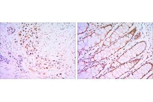 Immunohistochemical analysis of paraffin-embedded lung cancer tissues (left) and human rectum tissues (right) using KLF4 antibody with DAB staining. (KLF4 anticorps)