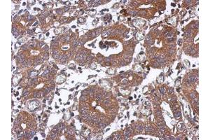 IHC-P Image Immunohistochemical analysis of paraffin-embedded human colon carcinoma, using PPM1J, antibody at 1:500 dilution. (PPM1J anticorps)