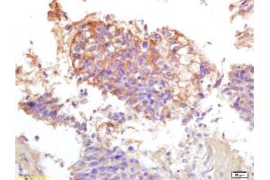 Formalin-fixed and paraffin embedded human lung carcinoma labeled with Anti-Phospho-ATP1A1(Tyr10) Polyclonal Antibody, Unconjugated (ABIN683173) at 1:200 followed by conjugation to the secondary antibody and DAB staining. (ATP1A1 anticorps  (pTyr10))