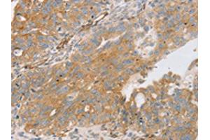 The image on the left is immunohistochemistry of paraffin-embedded Human breast cancer tissue using ABIN7131237(STX16 Antibody) at dilution 1/30, on the right is treated with fusion protein. (Syntaxin 16 anticorps)