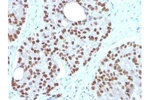Formalin-fixed, paraffin-embedded human Prostate Carcinoma stained with NKX3. (NKX3-1 anticorps  (AA 92-224))