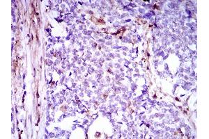 Immunohistochemical analysis of paraffin-embedded esophageal cancer tissues using NPC1 mouse mAb with DAB staining.