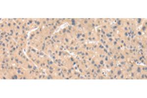Immunohistochemistry of paraffin-embedded Human liver cancer tissue using ZNF268 Polyclonal Antibody at dilution of 1:50(x200) (ZNF268 anticorps)