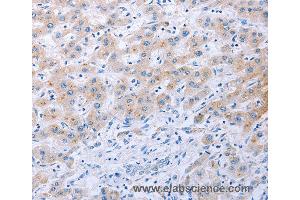 Immunohistochemistry of Human thyroid cancer using FGF4 Polyclonal Antibody at dilution of 1:40 (FGF4 anticorps)