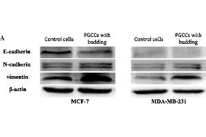 E-cadherin, N-cadherin, and vimentin expression in PGCCs with budding and control MCF-7 and MDA-MB-231 cells.