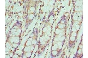Immunohistochemistry of paraffin-embedded human colon cancer using ABIN7156622 at dilution of 1:100 (IRF4 anticorps  (AA 180-451))