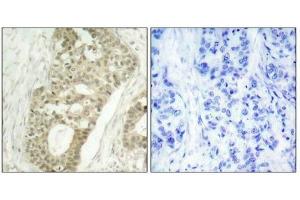 Immunohistochemical analysis of paraffin-embedded human breast carcinoma tissue using PKCd(Phospho-Ser645) Antibody(left) or the same antibody preincubated with blocking peptide(right).