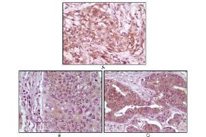 Immunohistochemical analysis of paraffin-embedded human pancreas carcinoma (A), esophagus carcinoma tissue (B) and ovary tumor tissue, showing cytoplasmic and membrane localization using 4E-BP1 mouse mAb with DAB staining. (eIF4EBP1 anticorps)