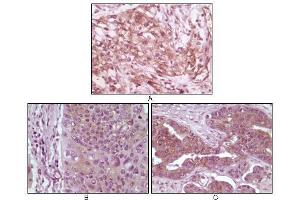 Immunohistochemical analysis of paraffin-embedded human pancreas carcinoma (A), esophagus carcinoma tissue (B) and ovary tumor tissue, showing cytoplasmic and membrane localization using 4E-BP1 mouse mAb with DAB staining.