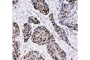 Peroxiredoxin 3 antibody and human lung cancer tissue tested by IHC-P
