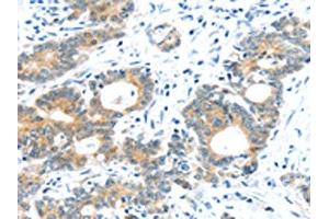 The image on the left is immunohistochemistry of paraffin-embedded Human colorectal cancer tissue using ABIN7192957(TUSC1 Antibody) at dilution 1/30, on the right is treated with synthetic peptide. (TUSC1 anticorps)